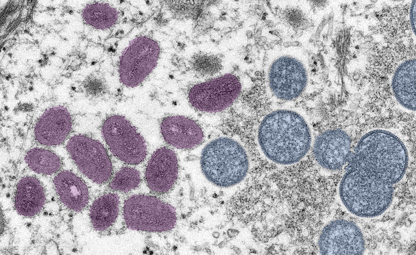 Clinical sample of the monkeypox virus.