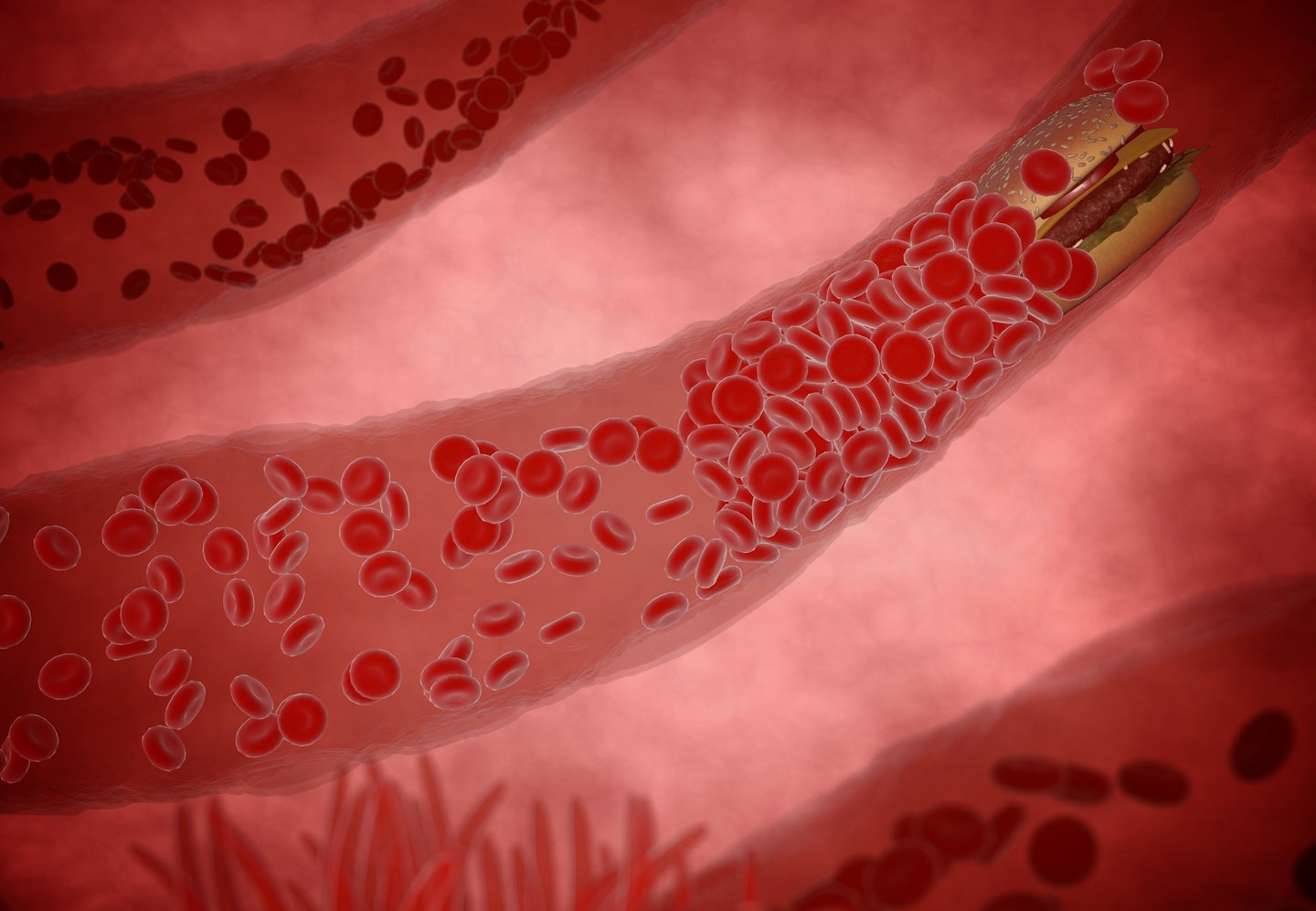 Arteries with red blood cells flowing through and a yellowish cholesterol clog in a medical illustration