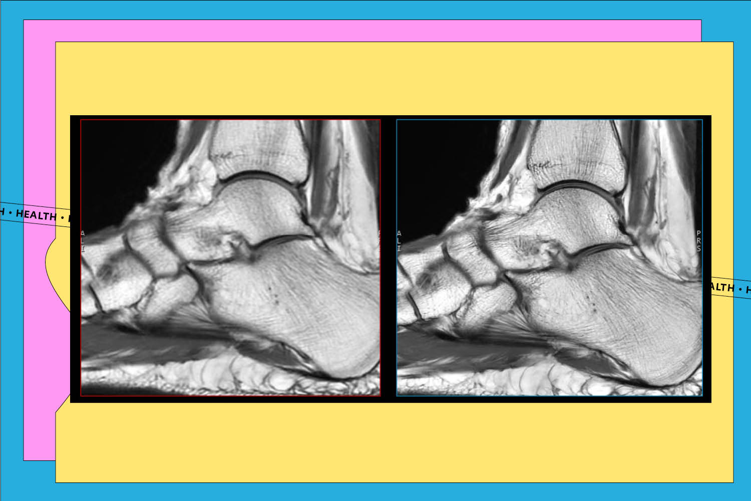 AIR Recon on ankle MRI