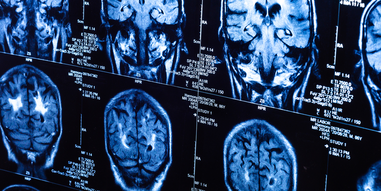 Some teenagers’ brains have been aging faster during the pandemic