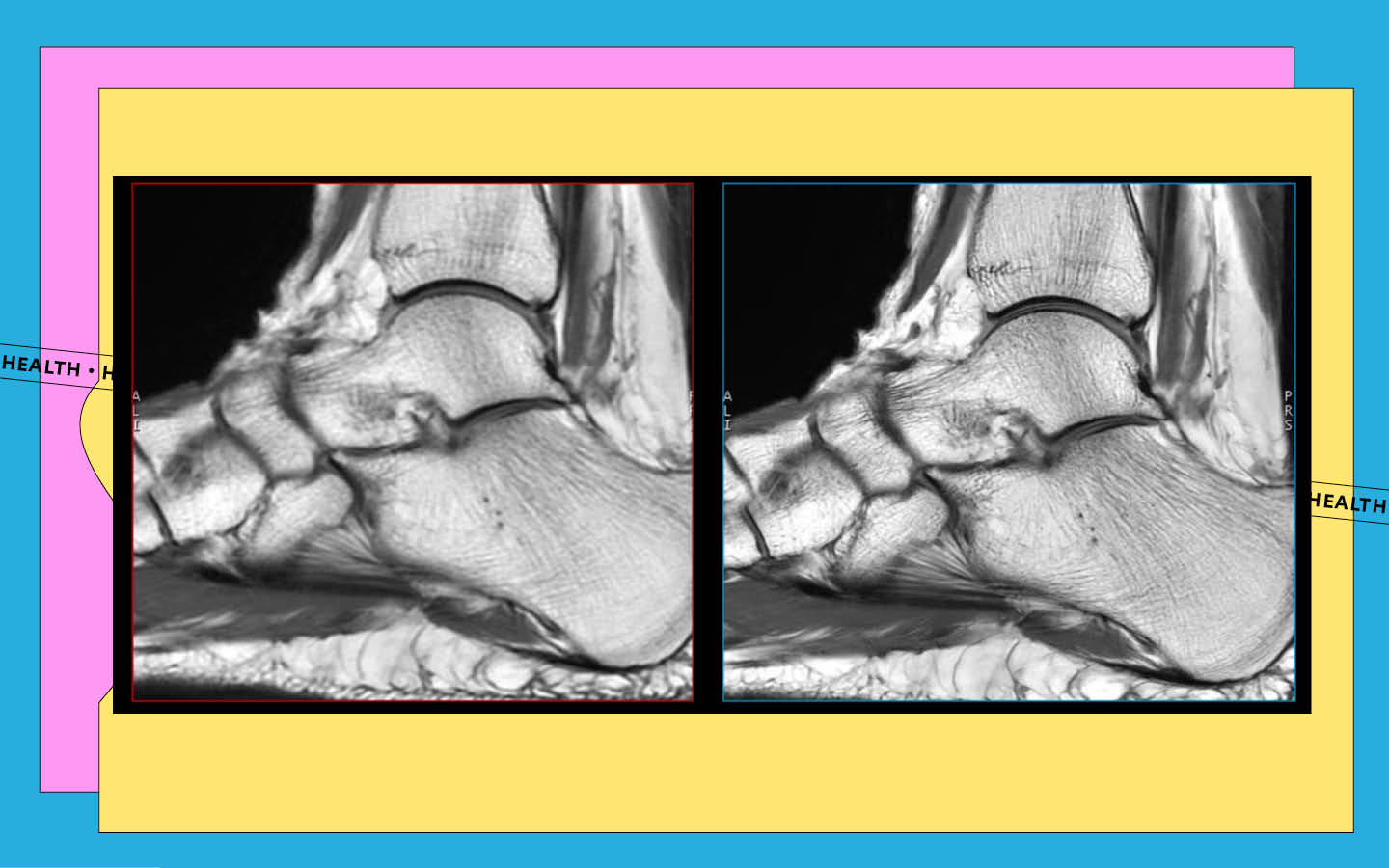 GE Healthcare AIR Recon sharper MRI images of ankle bones
