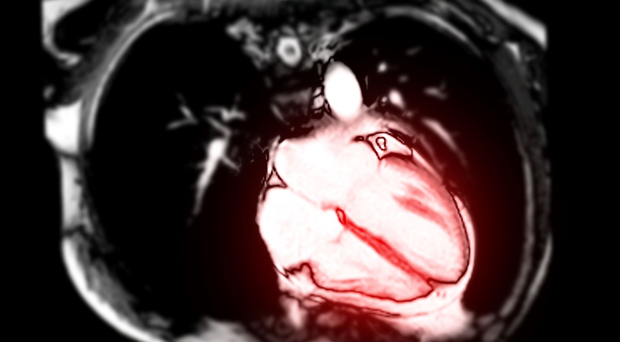 Myocarditis after COVID vaccines seen in MRI of heart