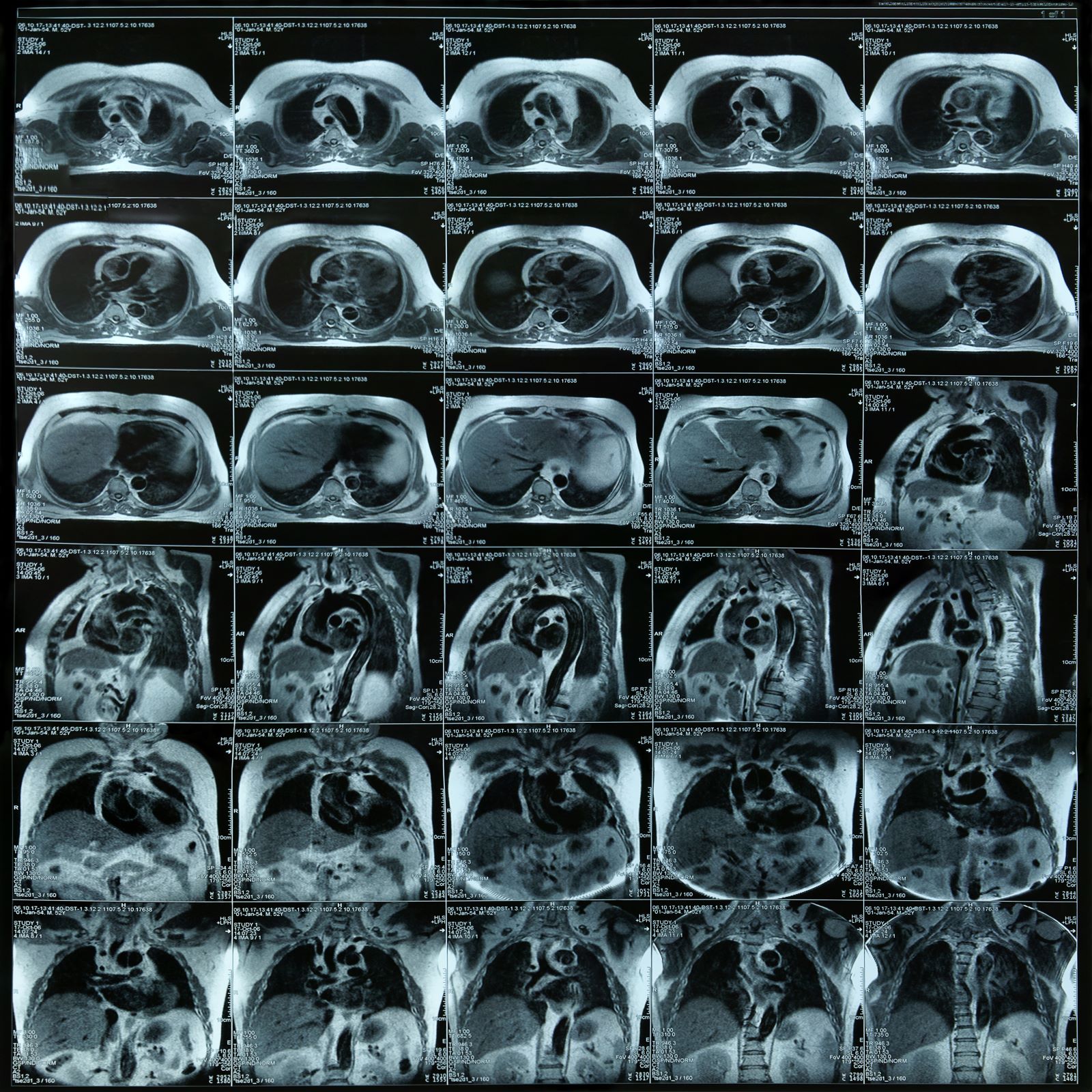 Angioplasty heart exam seen in multiple small black and white images