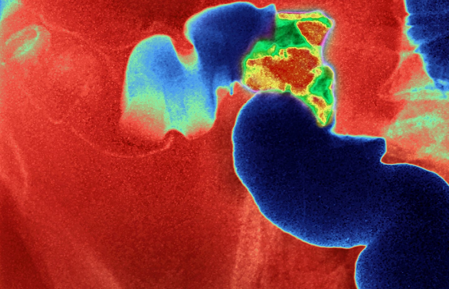 Colon cancer shown in abdominal X-ray in red, blue, and green