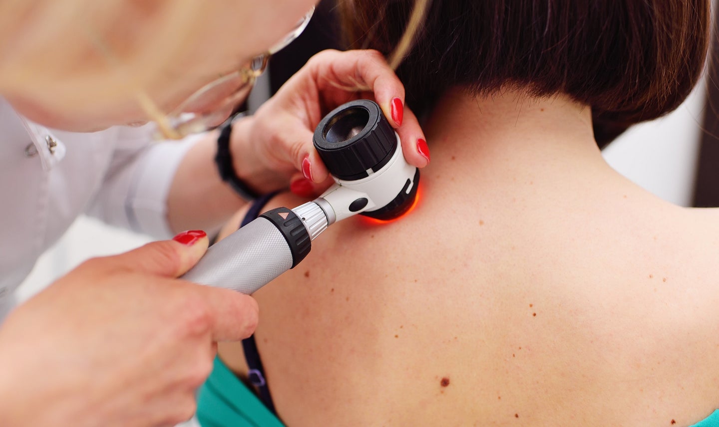 Dermatologist checking moles on skin cancer patient's back