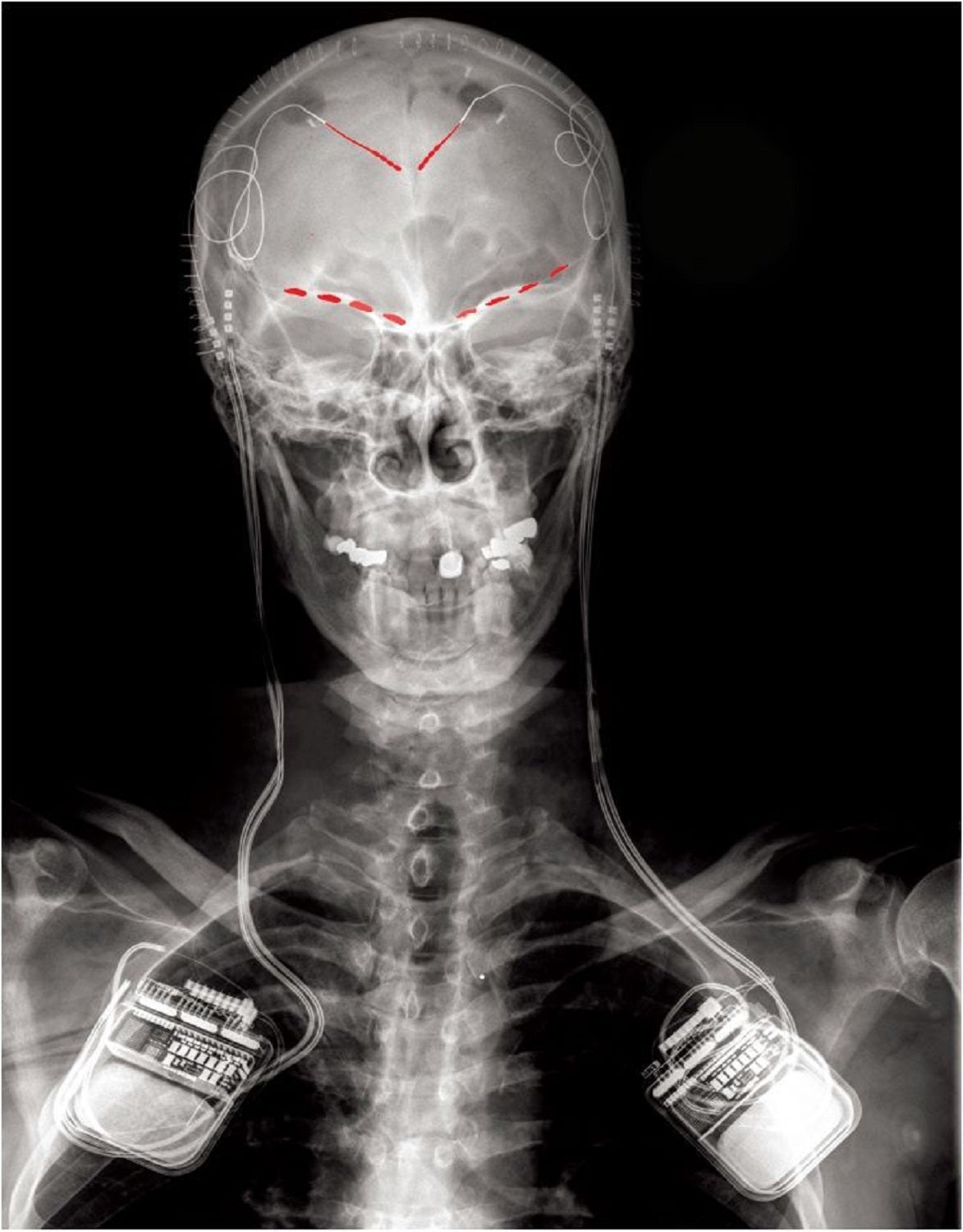 X-ray of chronic pain patient with activity tracking electrodes