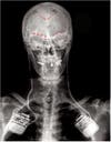 X-ray of chronic pain patient with activity tracking electrodes