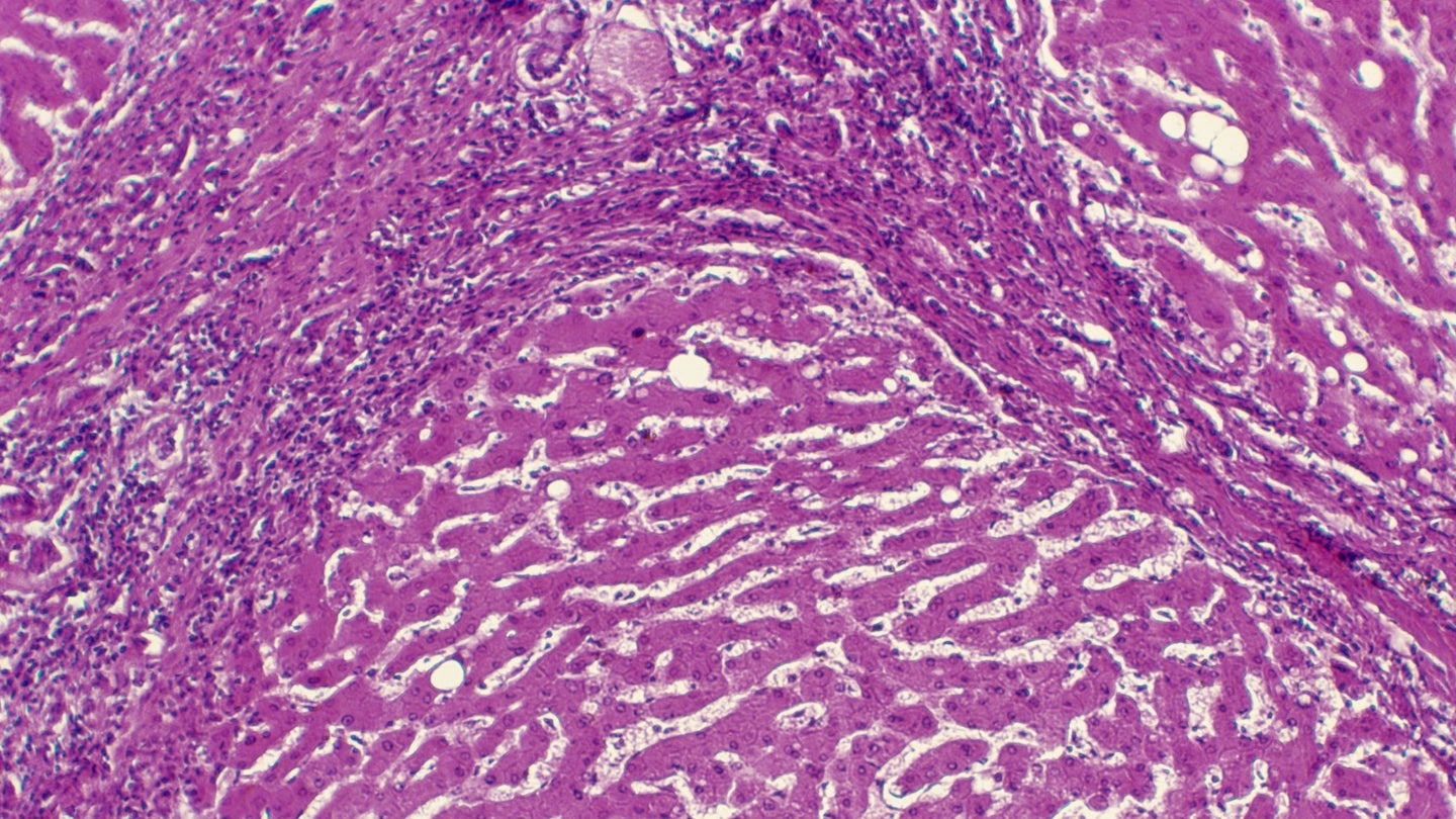 Histology image of the liver in a case of cirrhosis of the liver from alcoholism.