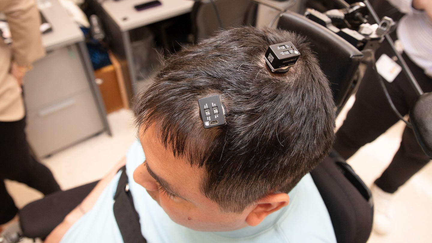 Patient with brain microchip implants atop head