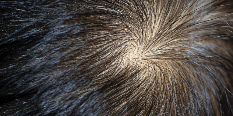 The swirls and whorls of your hairline come from multiple genes