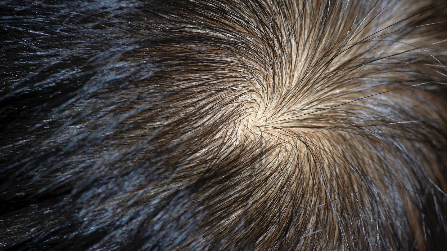 A hair whorl is a patch of hair growing in a circular pattern around a single point that is determined by the orientation of hair follicles.