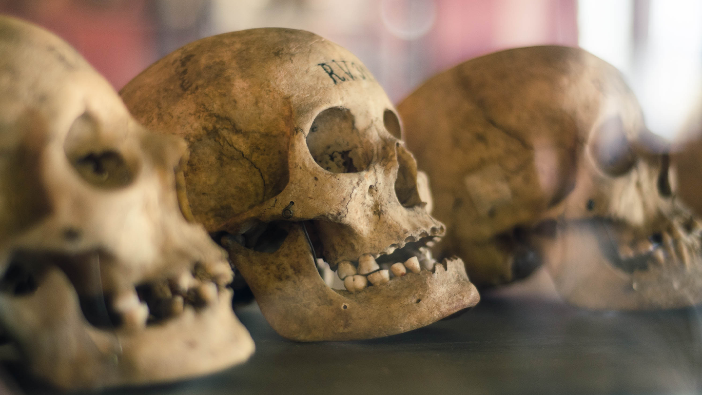 Three human skulls sitting on a shelf. Cranial modification has been used for millennia to reshape the human skull.