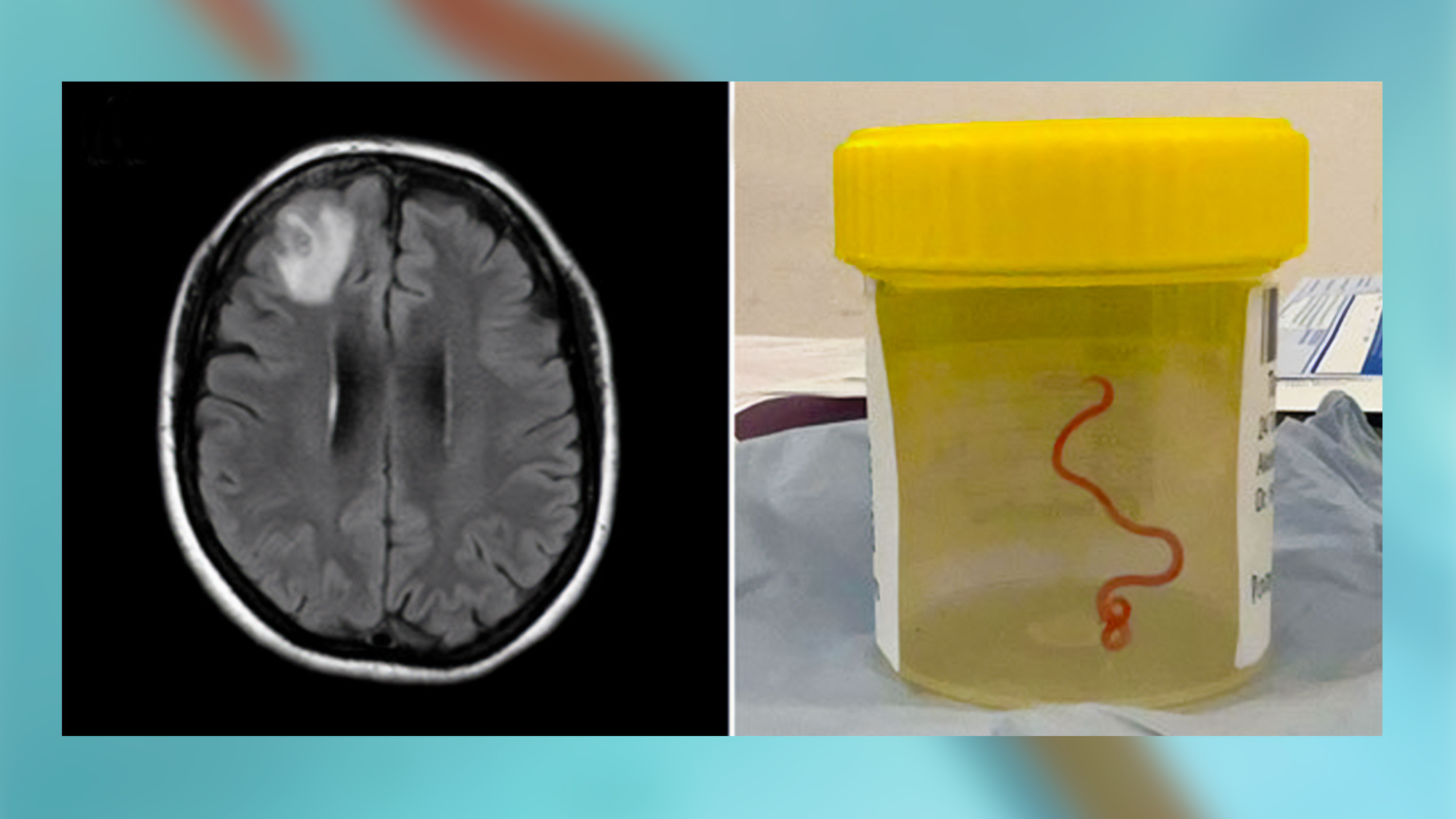 A magnetic resonance image of the patient’s brain by fluid-attenuated inversion recovery showing an enhancing right frontal lobe lesion (left). A live third-stage larval form of Ophidascaris robertsi removed from the patient’s right frontal lobe (right).