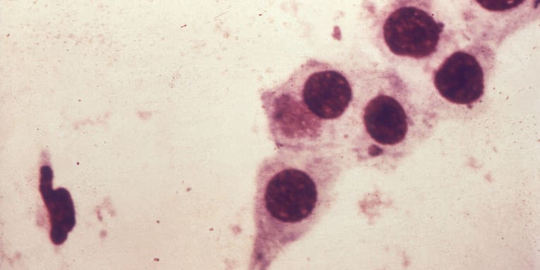 FDA authorizes at-home chlamydia and gonorrhea test for the first time