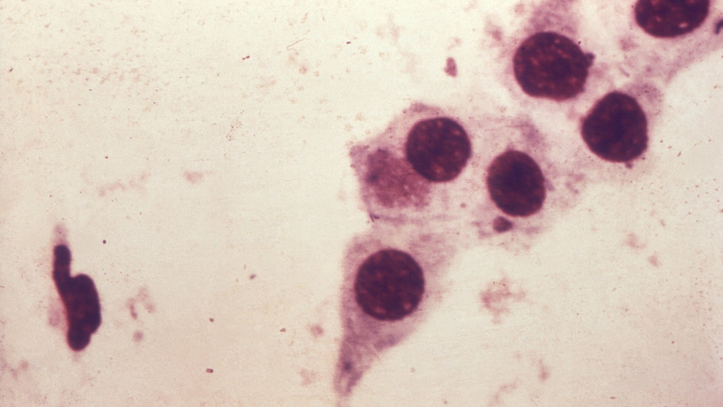 A photomicrograph of Chlamydia trachomatis taken from a urethral scrape. If left untreated, chlamydia can cause severe and costly reproductive and other health problems.