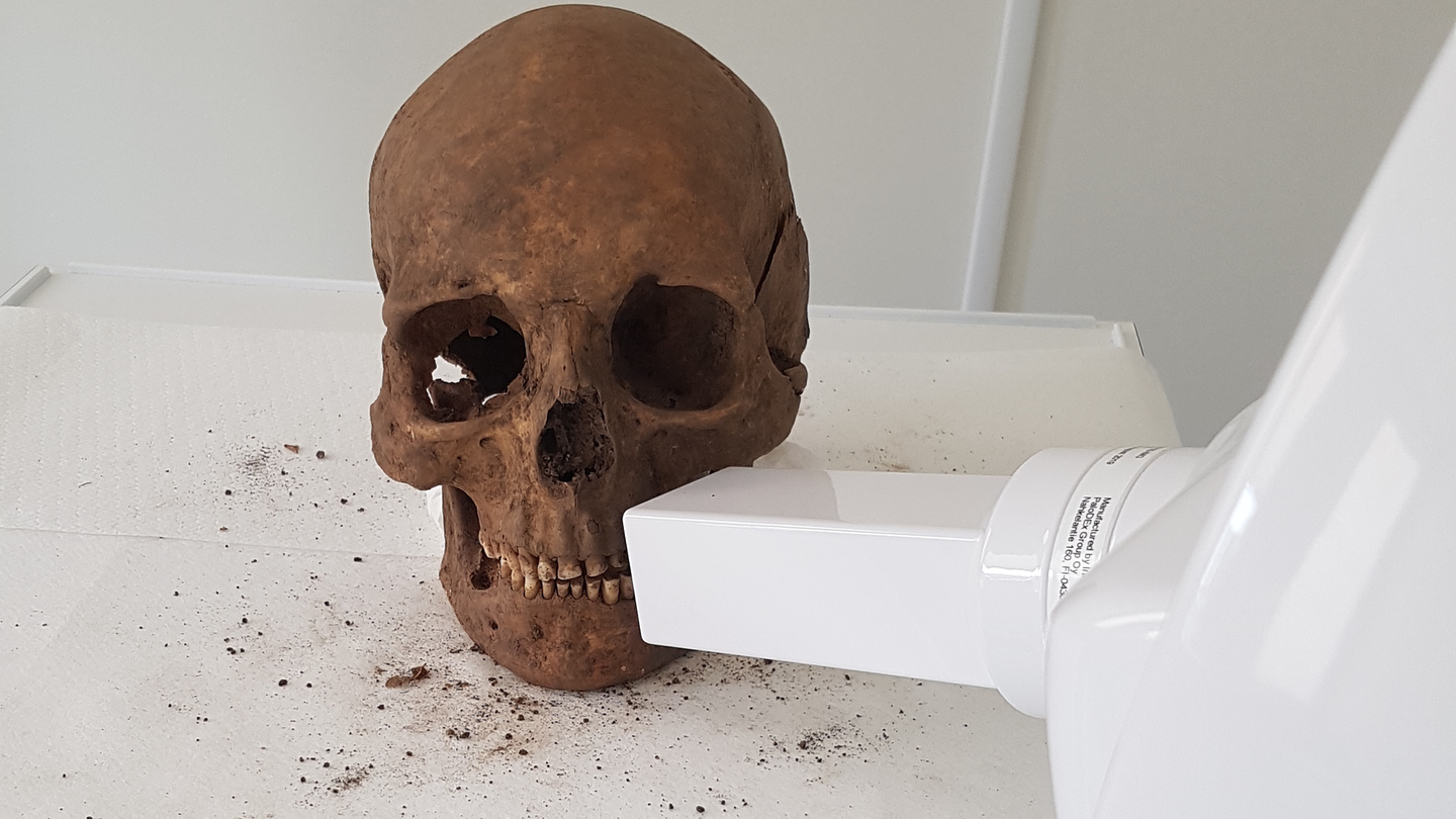 The skull of a Swedish Viking dating back to the 10th through 12th Century CE undergoes a dental examination.