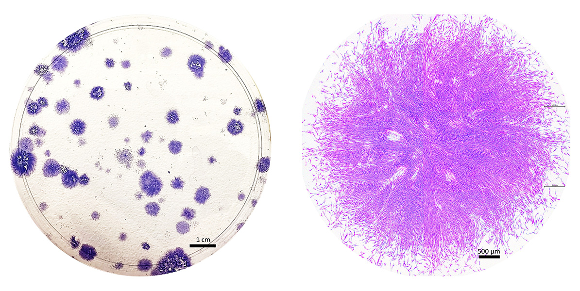 These purple blobs are clones of the stem cells that Caroline Gargett and colleagues identified in menstrual fluid. Each cluster began as a single cell. On the right, a close-up view of one blob, magnified at least 20 times, reveals the tightly packed cells’ whiskery, spindled shapes. CREDIT: K. SCHWAB, C. TAN AND C. GARGETT, THE RITCHIE CENTRE, HUDSON INSTITUTE OF MEDICAL RESEARCH AND MONASH UNIVERSITY DEPARTMENT OF OBSTETRICS AND GYNAECOLOGY, MELBOURNE AUSTRALIA