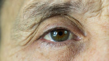 What you need to know about cataract surgery