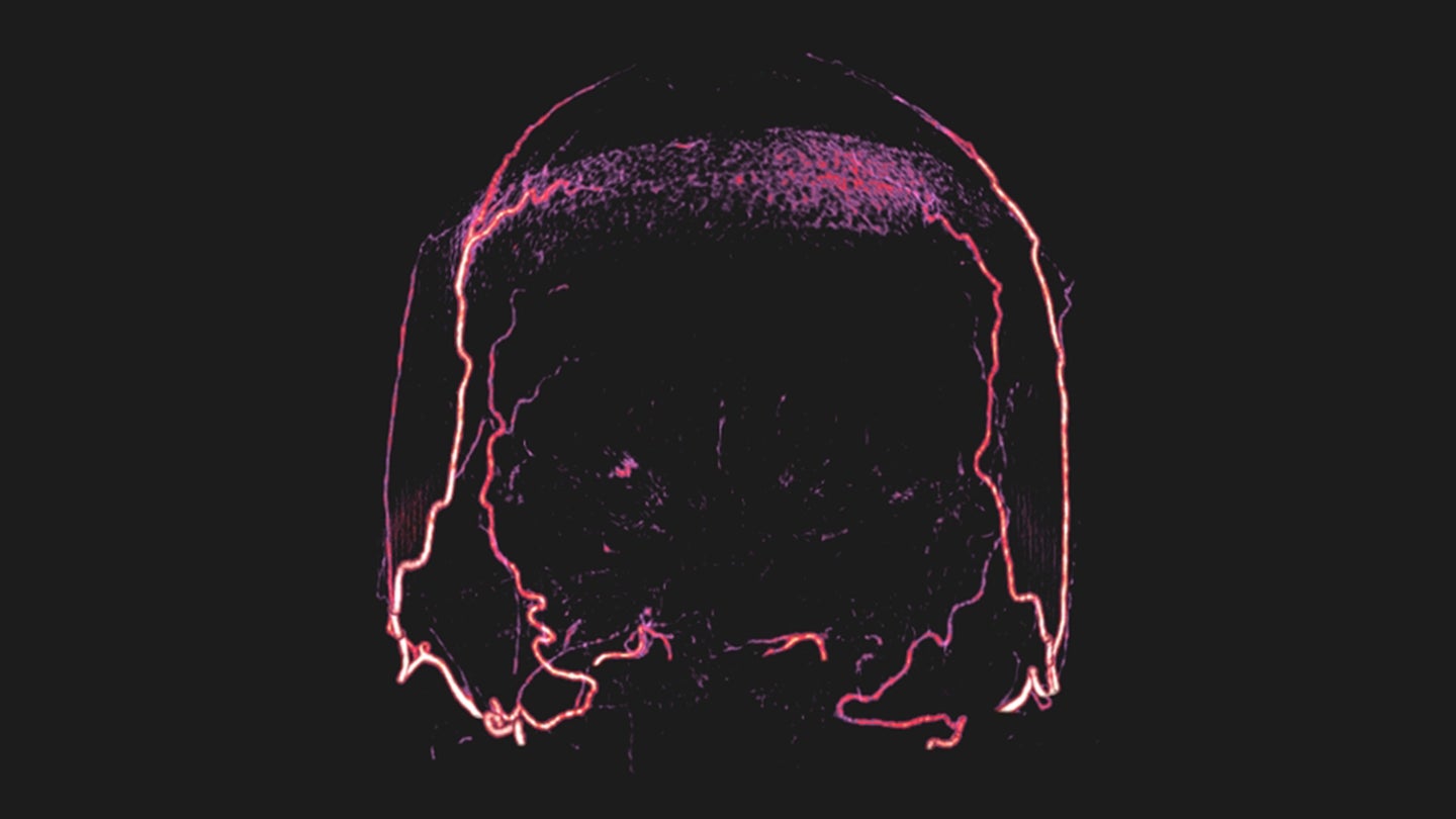 Imaging of the head of a brain dead patient show filling of the artery branches in the scalp, but filling of the arteries in the brain is absent. 