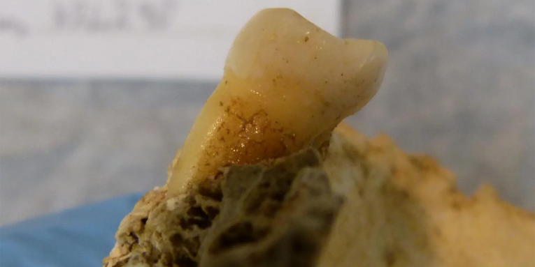 Rare traces of tooth decay and gum disease found in Bronze Age teeth