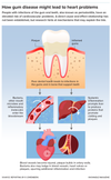 Research exploring the link between gum disease and cardiovascular problems suggests that chronic inflammation and oral bacteria play a role. Credit: Knowable Magazine