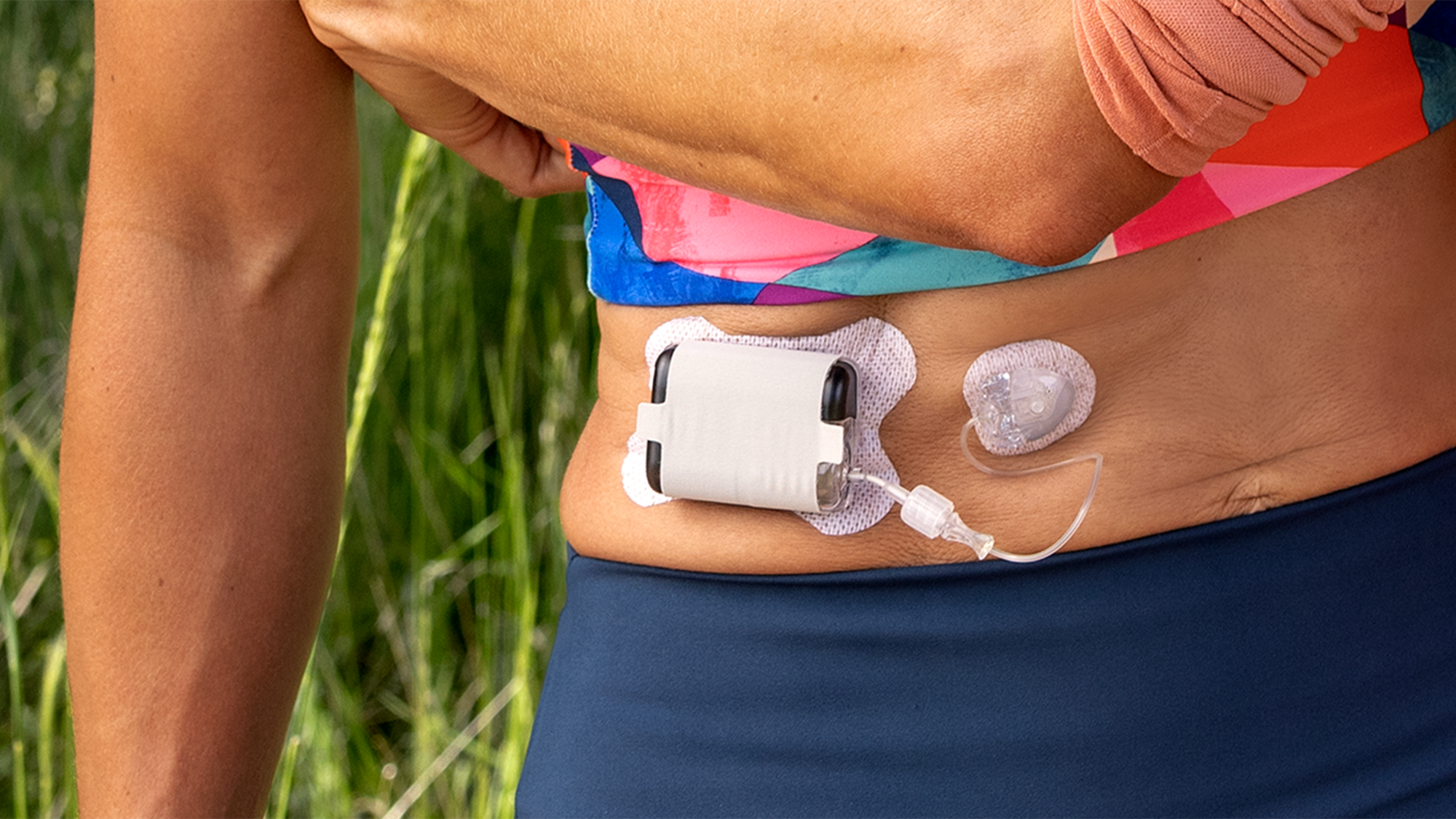 Tandem insulin pump installed on woman's stomach