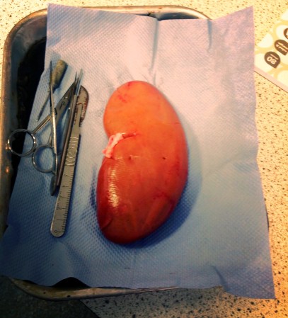 Technique Allows Kidney Transplants From Any Donor