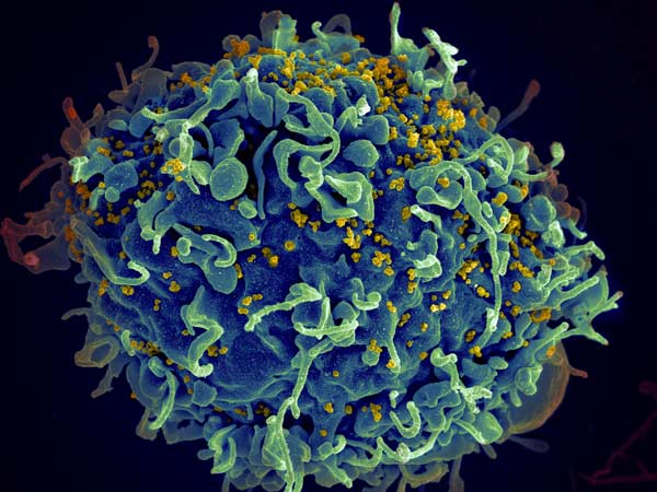“Genetic Scissors” Could Completely Eliminate HIV From Cells