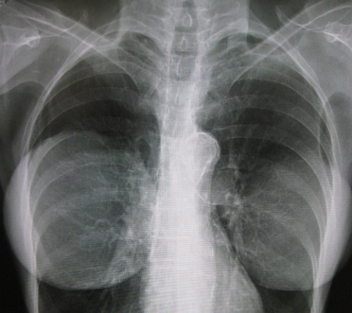 In Japanese Study, Stem Cell Injections Shown to Provide Simple Route to Breast Augmentation