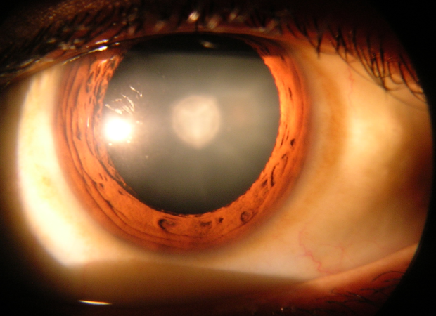 Stem Cells Can Regenerate The Lens In Your Eye