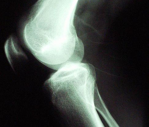By Stimulating Stem Cells, Bioactive Nanogel Regenerates Cartilage in Joints
