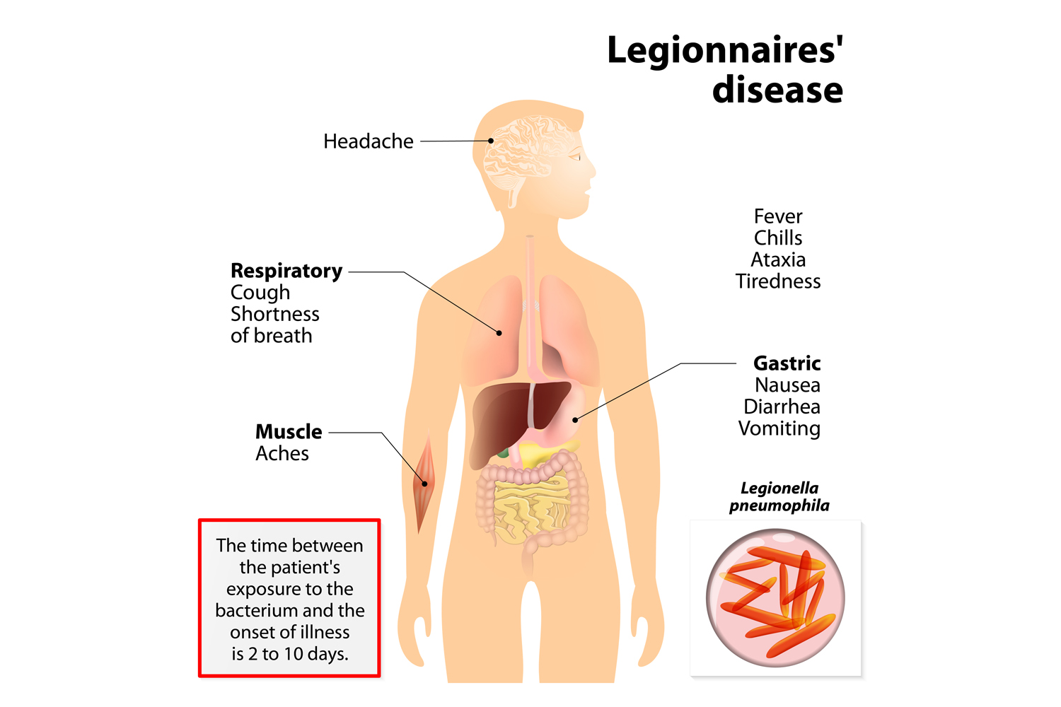 LEARN ABOUT LEGIONNAIRES DISEASE visual data 8