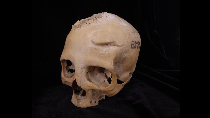 4,000 year-old Egyptian skulls show attempts at brain surgery
