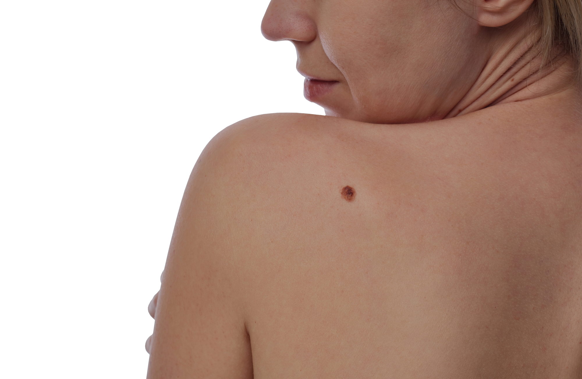 woman with mole on back