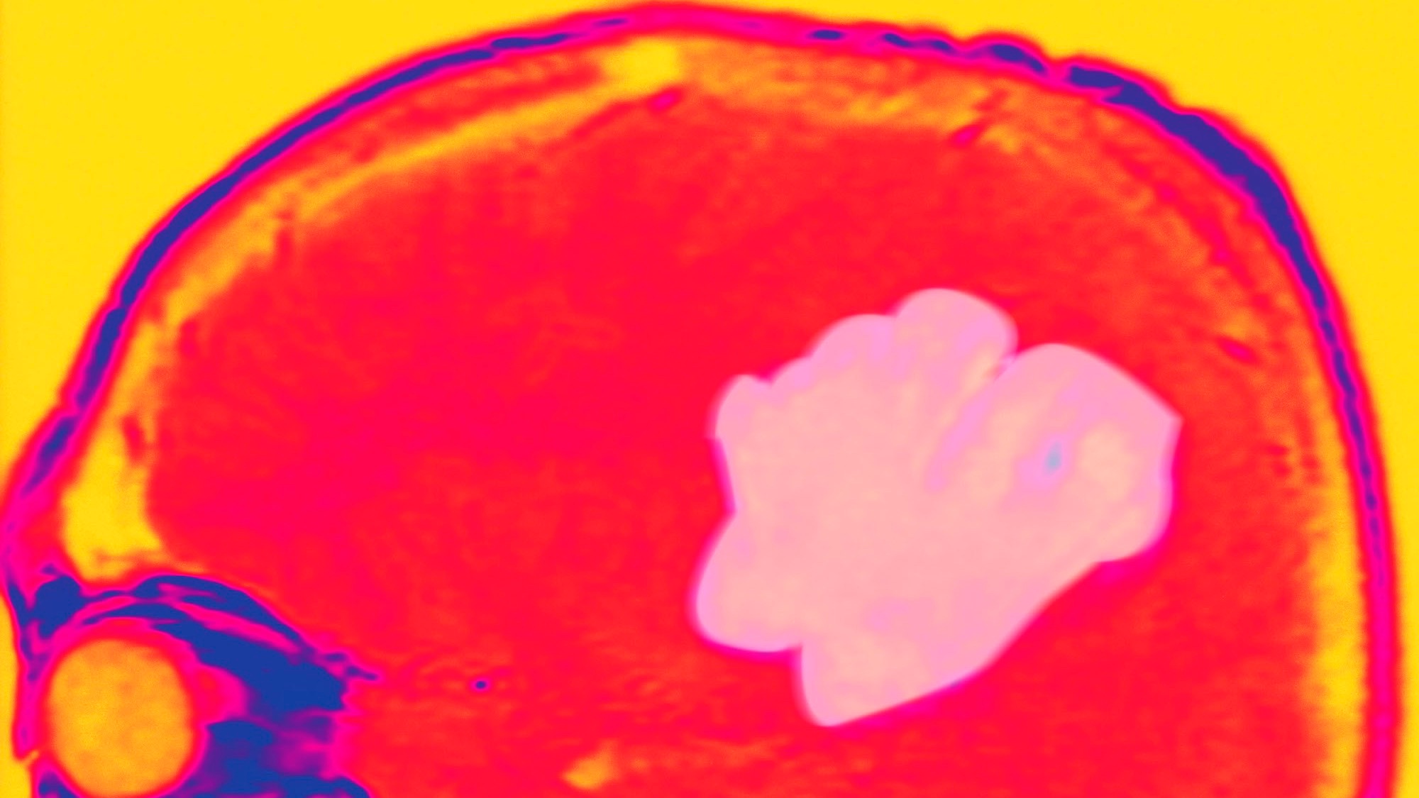 Glioblastoma. Absence Of Edema, Generalized Epileptic Seizures Due To Disseminated Cells Which Have Invaded The Cortical Region. Gadolinium Enhanced Mri T1. (Photo By BSIP/UIG Via Getty Images)