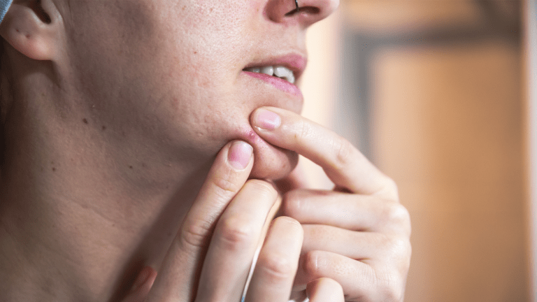 a woman popping a red pimple on her chin