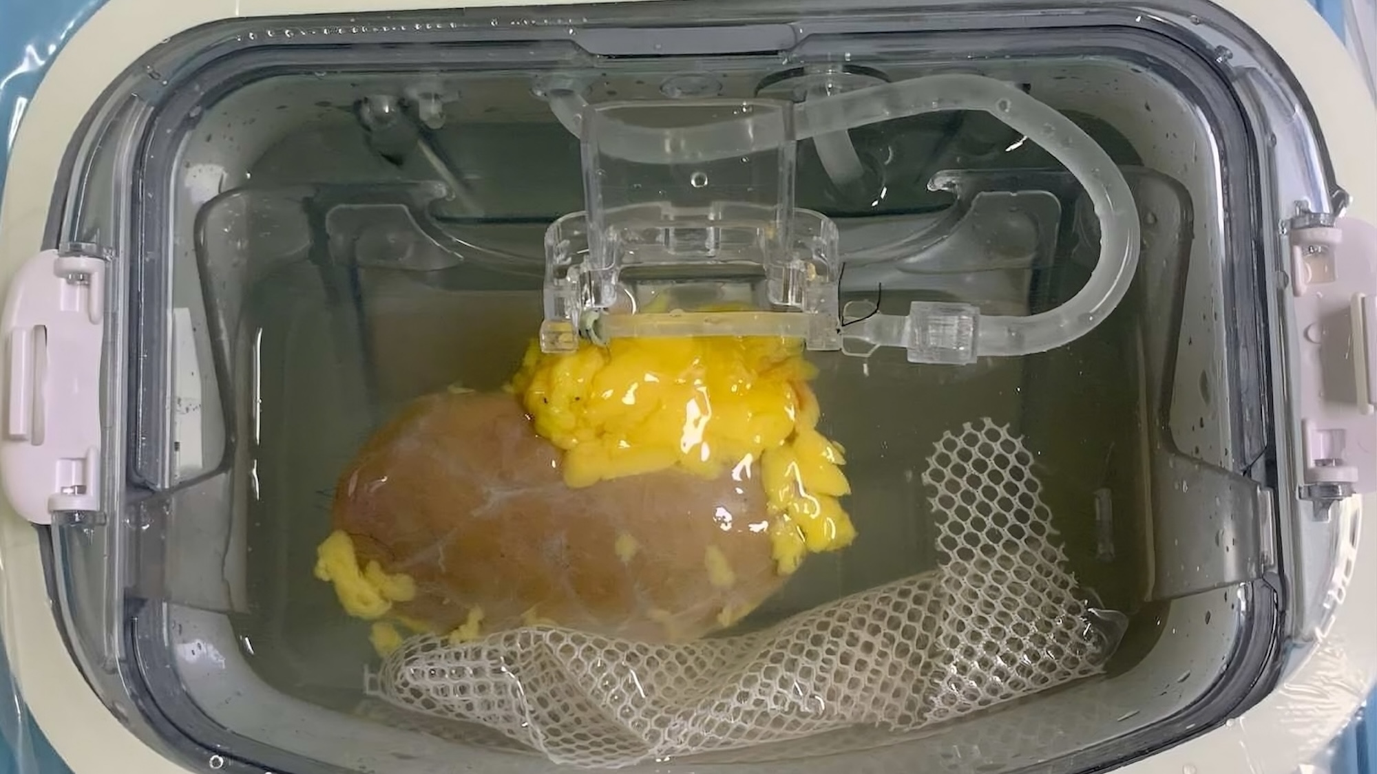 Kidney transplant in container