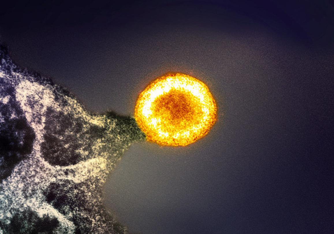 A highly magnified microscopic image shows a bright, glowing, spherical HIV virus particle (virion) colored yellow and orange, emerging or budding from the dark, textured surface of an infected host cell. The background is a dark, uniform gray-blue.