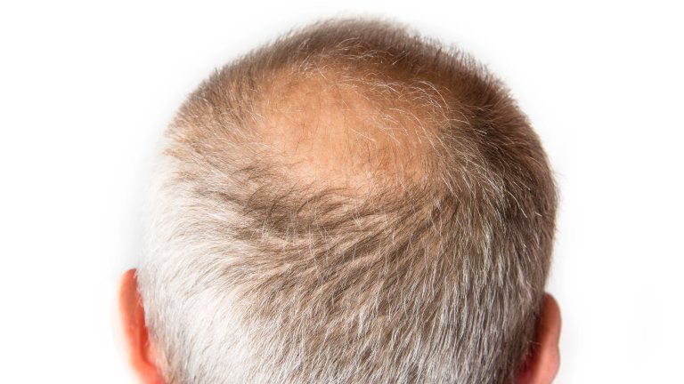 A close-up view of the back of a person's head, showing a receding hairline and a circular patch of thinning hair or male pattern baldness on the crown, surrounded by short, gray and brown hair. The background is pure white.