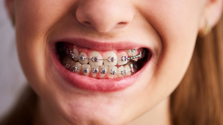 A close-up of a person's mouth smiling, showing teeth fitted with metal dental braces on both the upper and lower rows. The image focuses on the orthodontic brackets and wires, with the person’s nose and lips framing the smile.