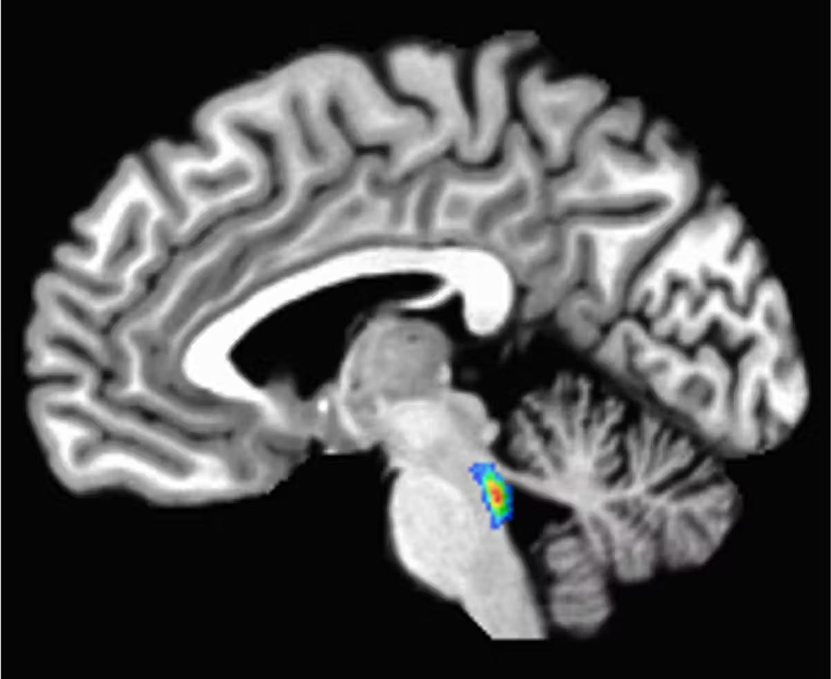 The locus coeruleus, which means ‘blue spot,’ is located in the brain stem, the lowest part of the brain.