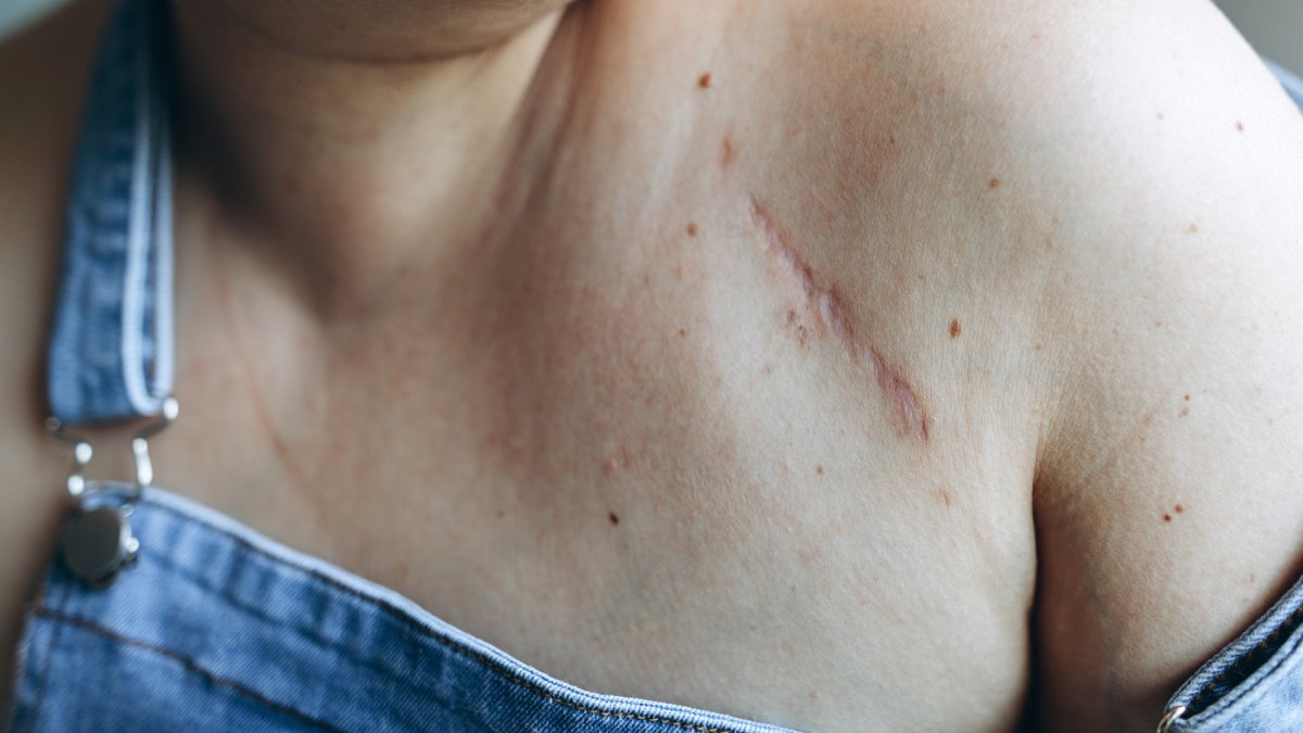 Why scars never disappear