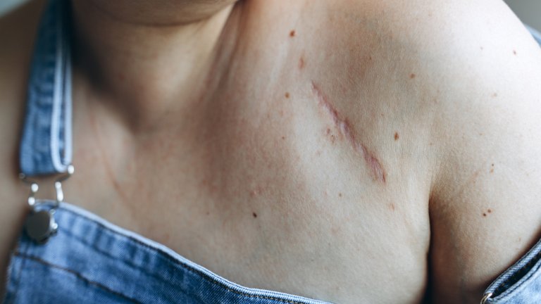 Close up photo of white woman wearing jean overalls showing a scar on her upper left chest several inches long.