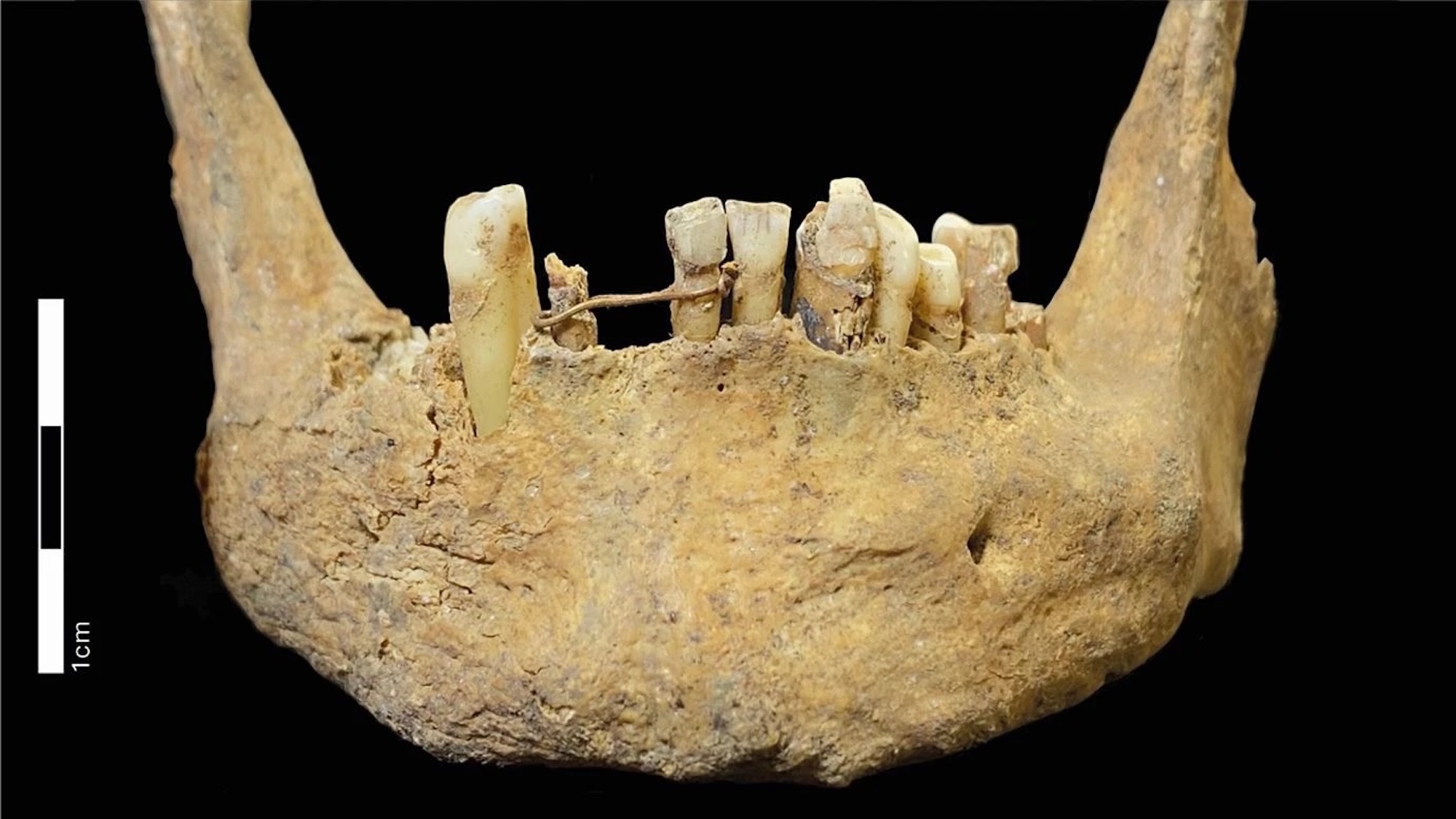 Jaw bone exhibiting gold wire dental ligature around bottom teeth
