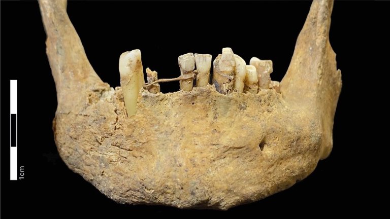 Jaw bone exhibiting gold wire dental ligature around bottom teeth