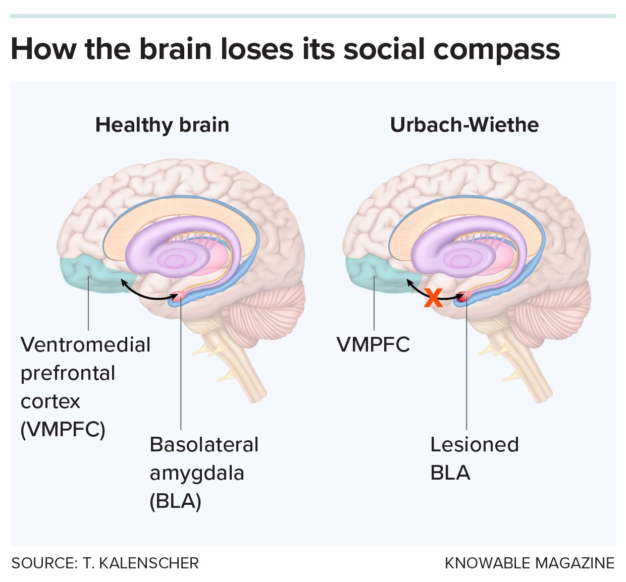 Social decision-making A graphic compares functioning in social decision-making in a brain of someone with Urbach-Wiethe disease and a normal brain.