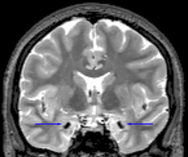 Brain scan Urbach-Wiethe disease An MRI scan shows two unusual, dark spots with arrows pointing to them.