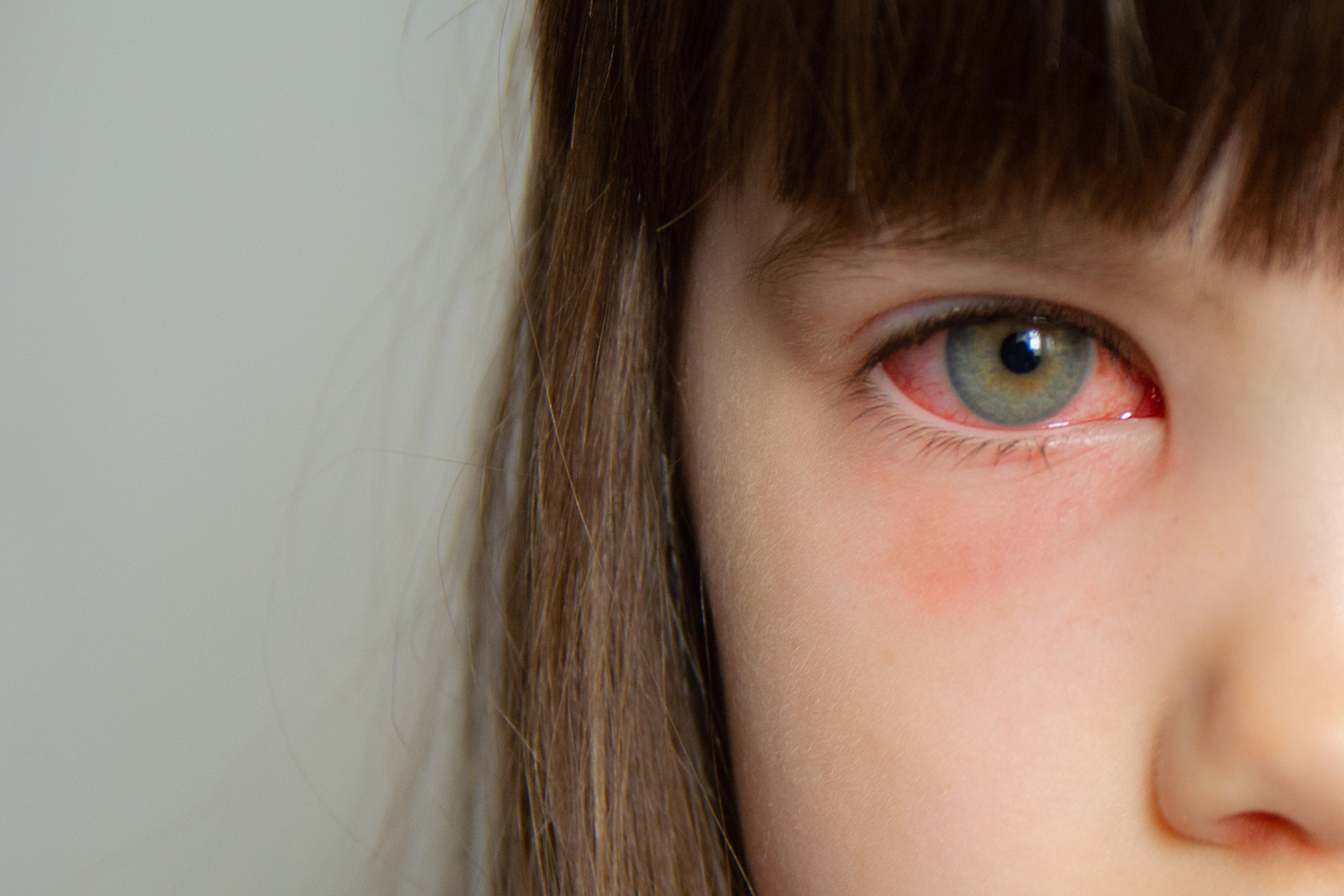 Pink eye Conjunctivitis in a girl's eye; Shutterstock ID 1897573918; purchase_order: PopSci; job: ; client: ; other: