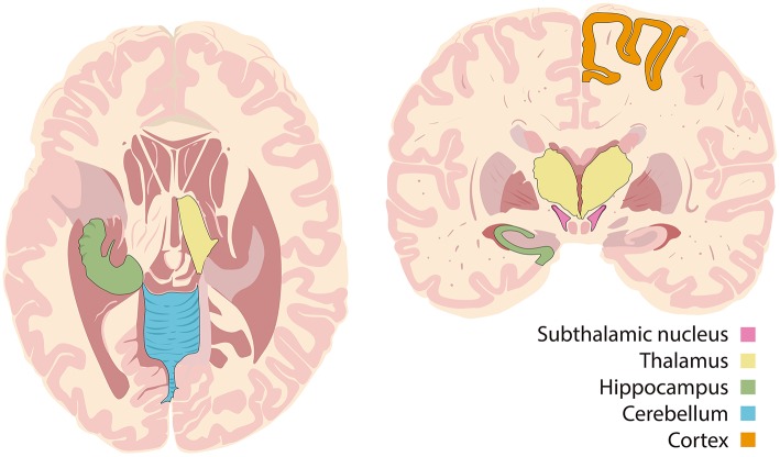 Two views of the brain highlighting different parts of the organ, including the subthalamic nucleus, thalamus, hippocampus, cerebellum, and cortex.