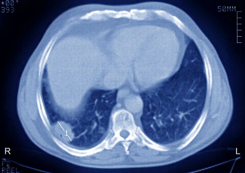 lung-cancer-on-CT-scan.jpg